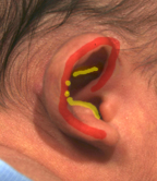 Cup Ear Zones of Constriction